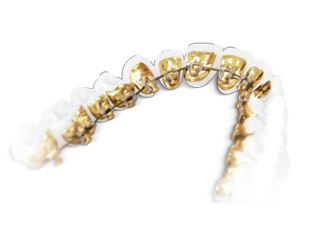Photo of Incognito Orthodontic Braces from 3m.com. © 3M 2015. All rights reserved.