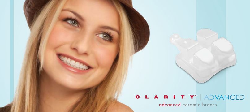 Photo of Clarity Advanced Braces from 3m.com. © 3M 2015. All rights reserved.