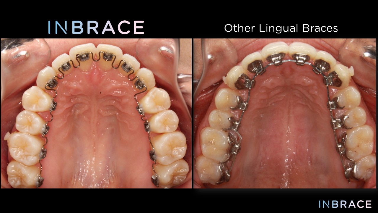 INBRACE™ Lingual Braces - Clarity Orthodontics